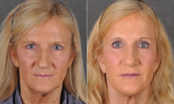 Blepharoplasty Before and After Photos in Omaha, NE, Case 16826