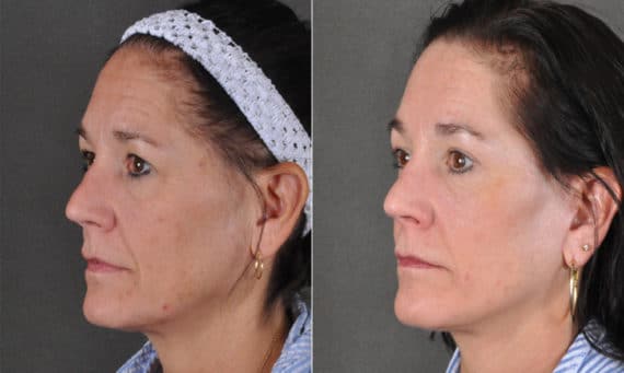 Blepharoplasty Before and After Photos in Omaha, NE, Case 16836