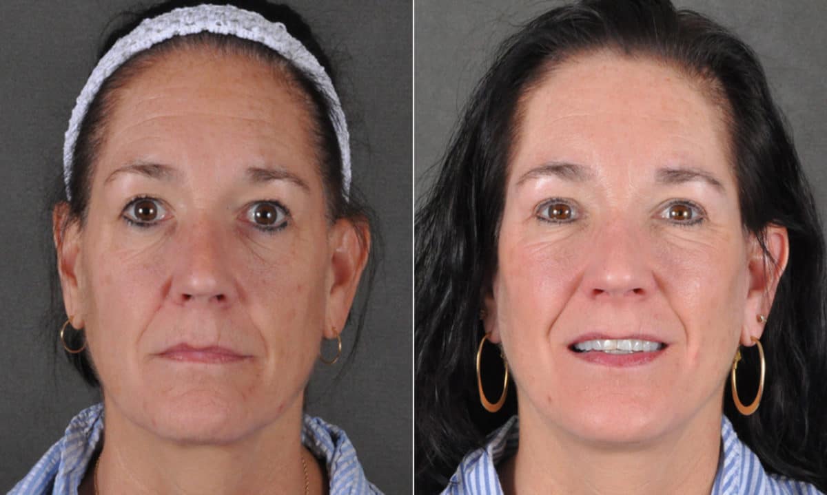 Blepharoplasty Before and After Photos in Omaha, NE, Case 16836