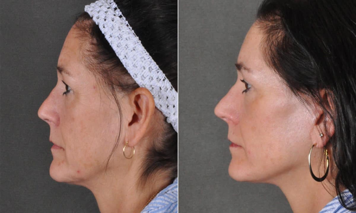 Blepharoplasty Before and After Photos in Omaha, NE, Case 16836