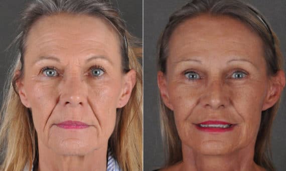 Facelift Before and After Photos in Omaha, NE, Case 16895