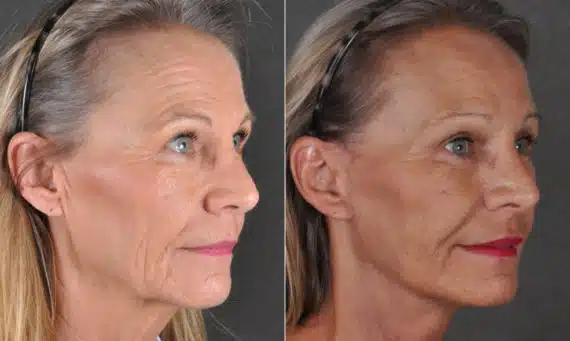 Facelift Before and After Photos in Omaha, NE, Case 16895