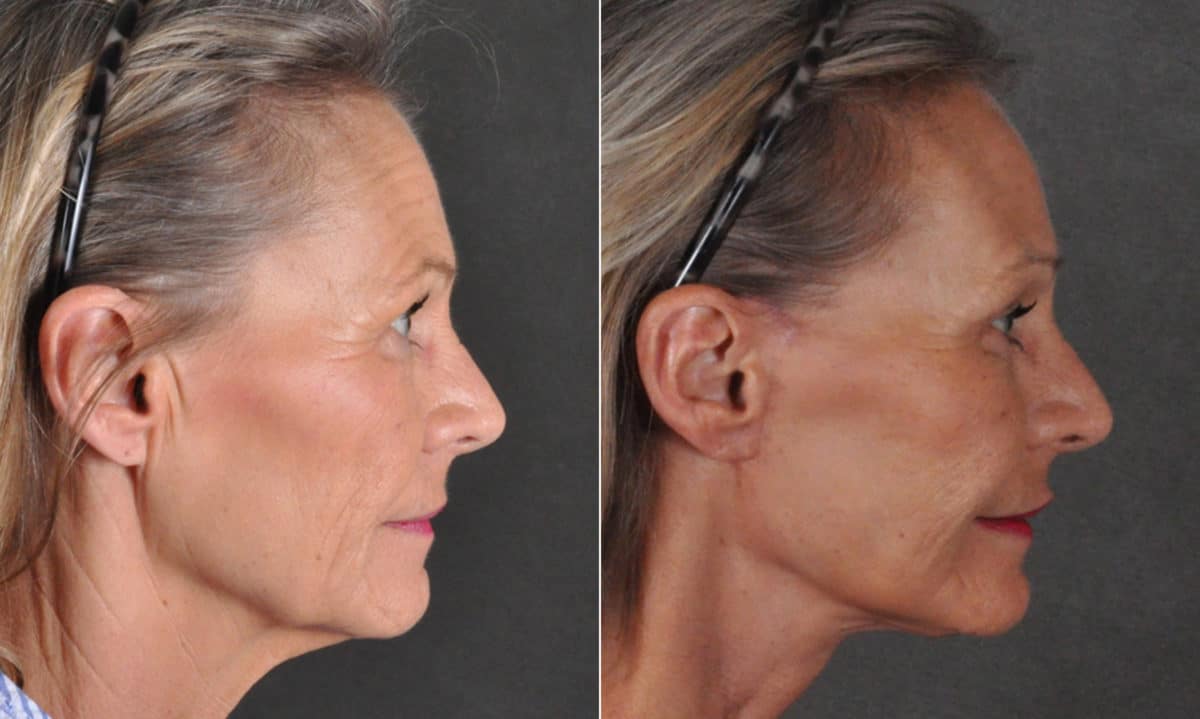 Facelift Before and After Photos in Omaha, NE, Case 16895