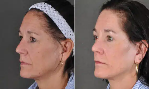 Facelift Before and After Photos in Omaha, NE, Case 16913