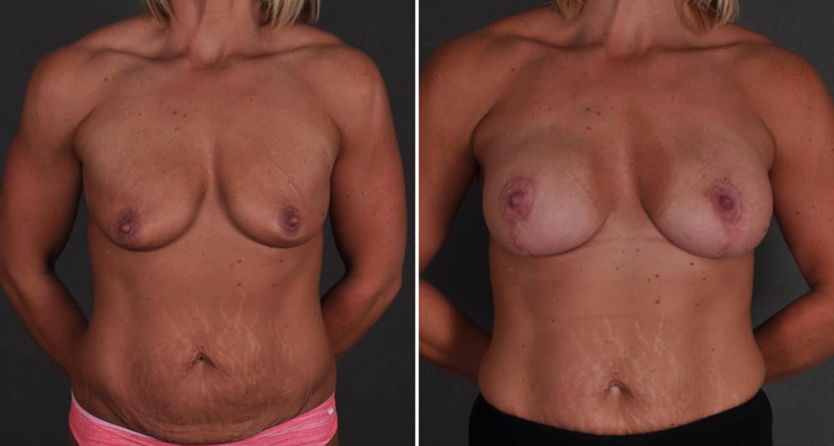 Breast Augmentation Before and After Photos in Omaha, NE, Case 9445