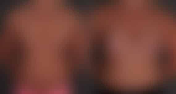 Breast Augmentation Before and After Photos in Omaha, NE, Case 9445