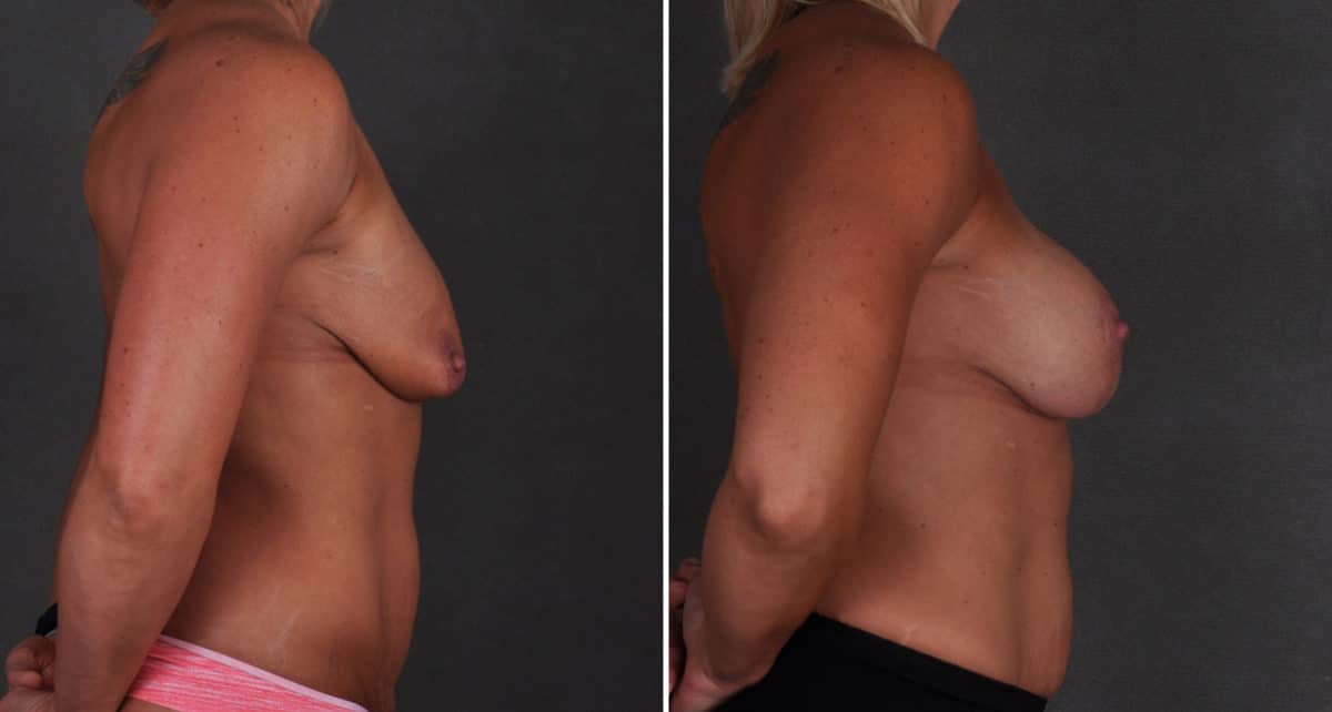 Breast Augmentation Before and After Photos in Omaha, NE, Case 9445