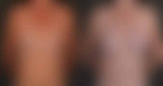 Breast Augmentation Before and After Photos in Omaha, NE, Case 17197