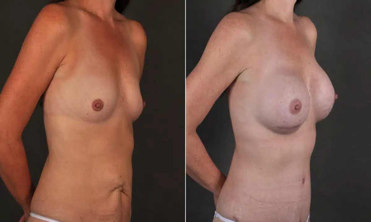 Breast Augmentation Before and After Photos in Omaha, NE, Case 17197