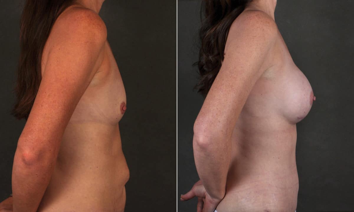 Breast Augmentation Before and After Photos in Omaha, NE, Case 17197