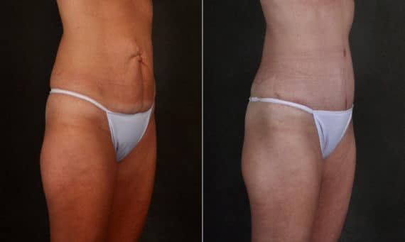 Liposuction Before and After Photos in Omaha, NE, Case 17211