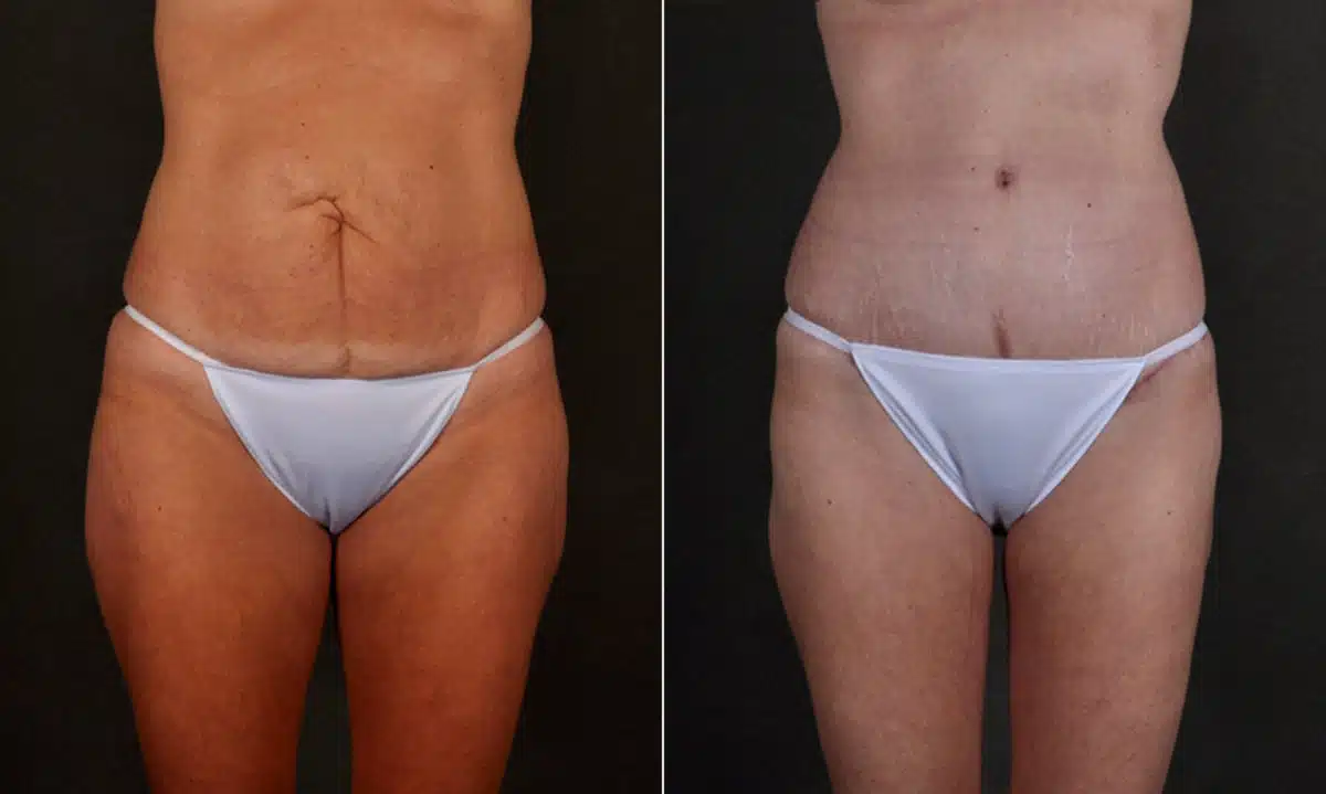 Liposuction Before and After Photos in Omaha, NE, Case 17211