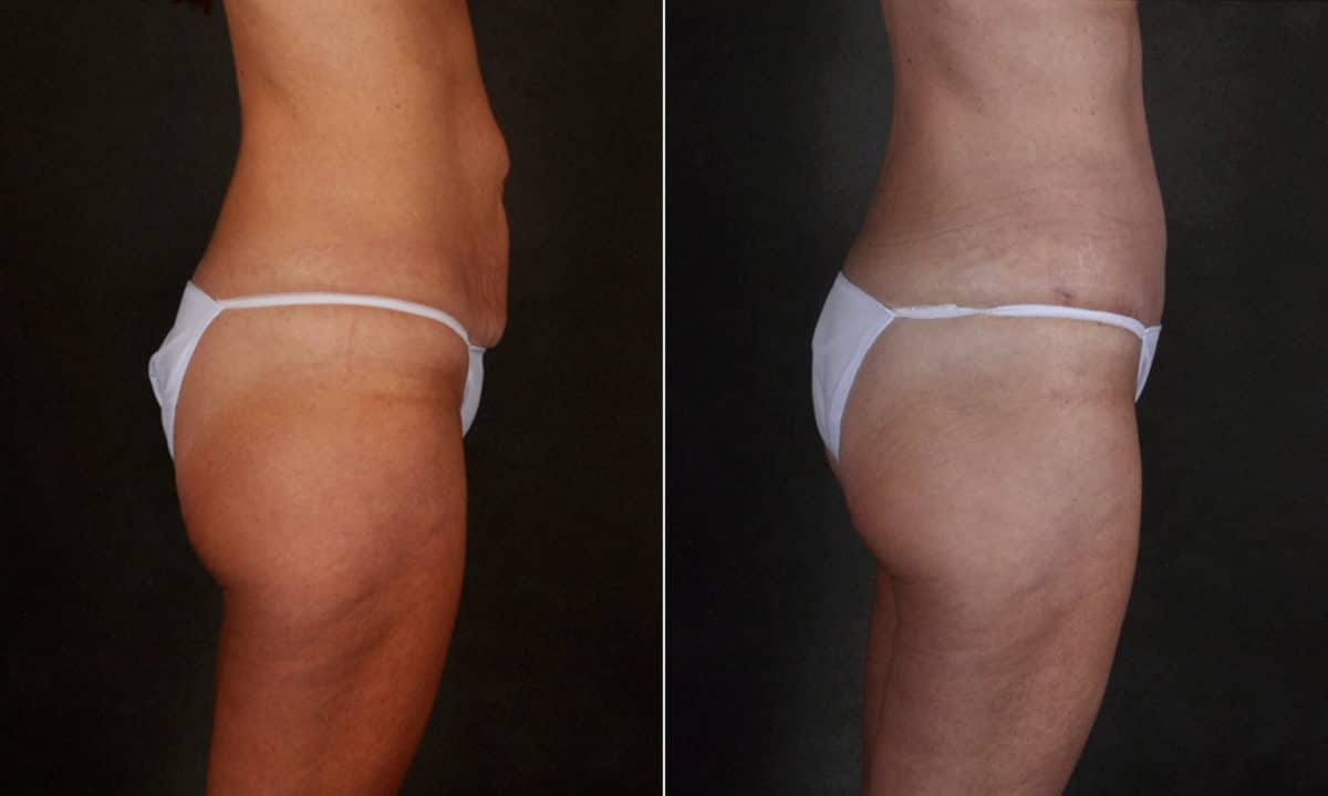 Liposuction Before and After Photos in Omaha, NE, Case 17211