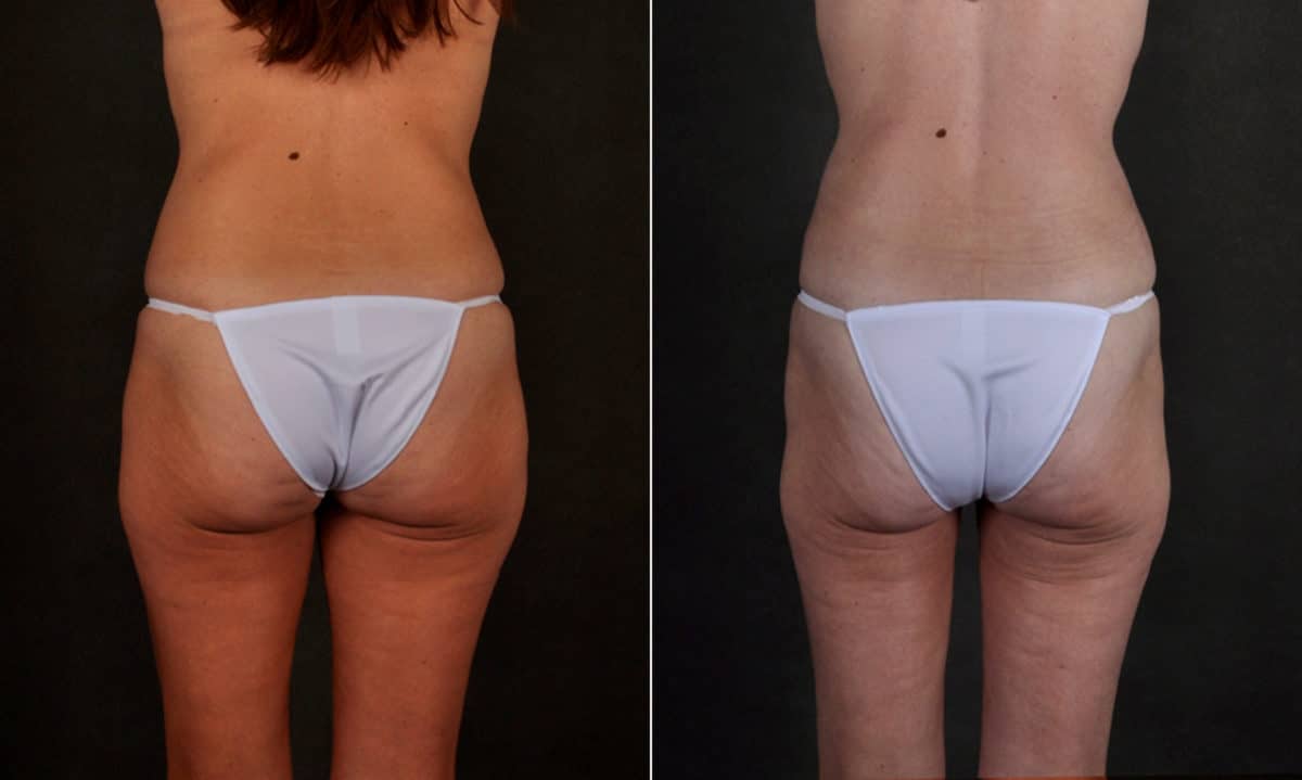 Liposuction Before and After Photos in Omaha, NE, Case 17211