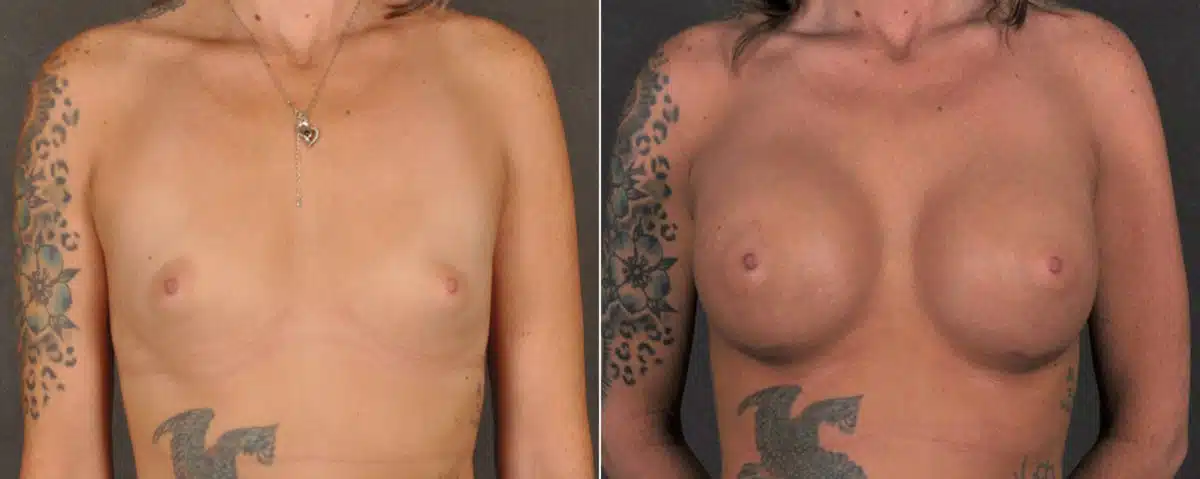 Breast Augmentation Before and After Photos in Omaha, NE, Case 17234