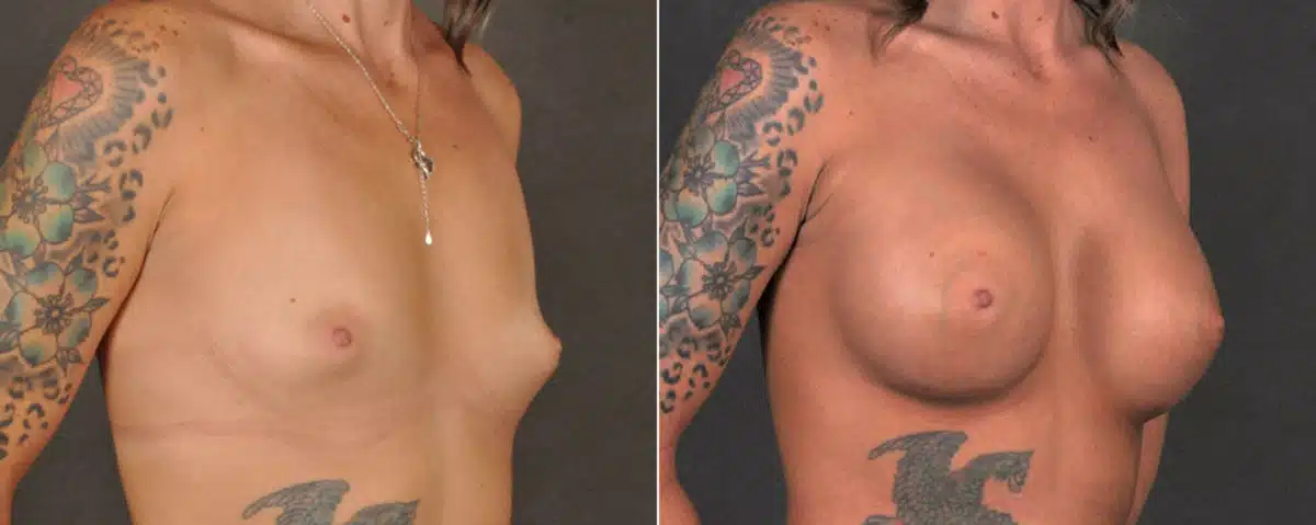 Breast Augmentation Before and After Photos in Omaha, NE, Case 17234