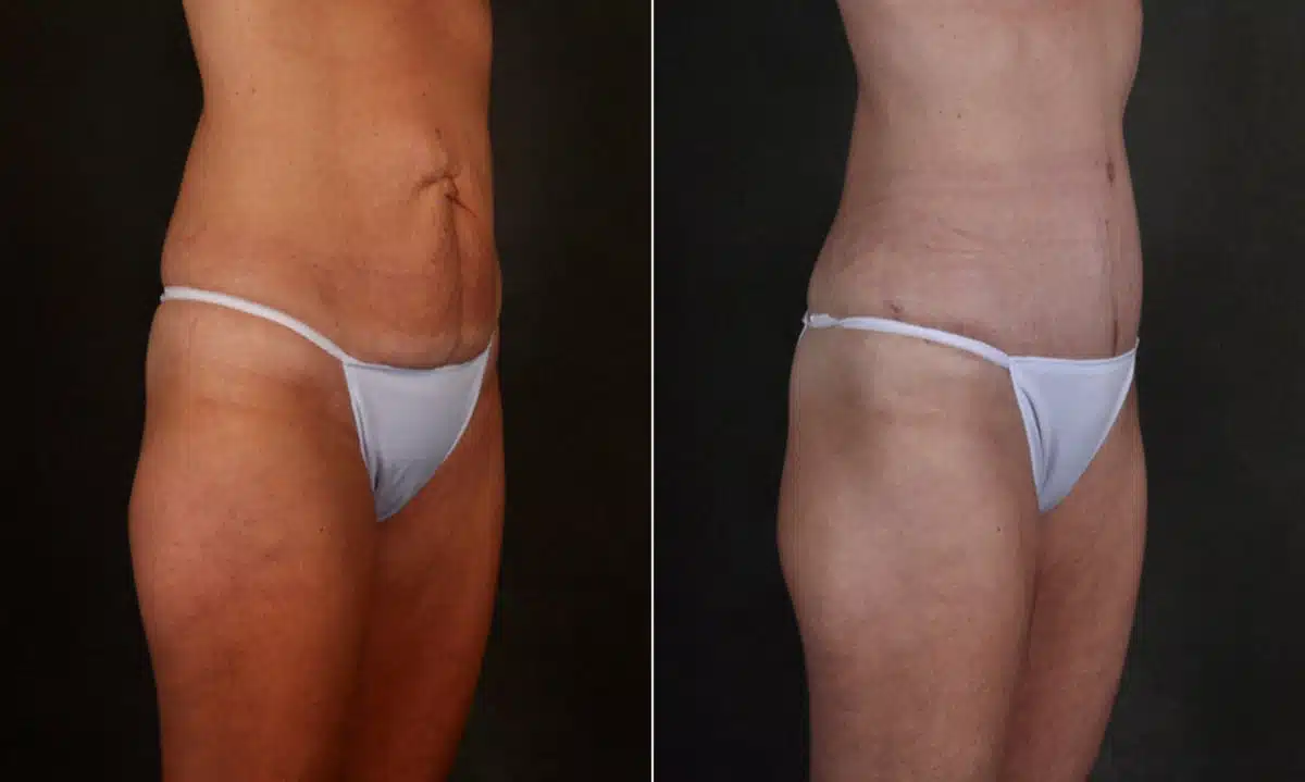 Case 17253, Tummy Tuck Before and After Photos Tummy Tuck Before and After Photos in Omaha, NE, Case 17253