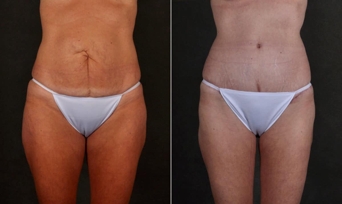 Case 17253, Tummy Tuck Before and After Photos Tummy Tuck Before and After Photos in Omaha, NE, Case 17253