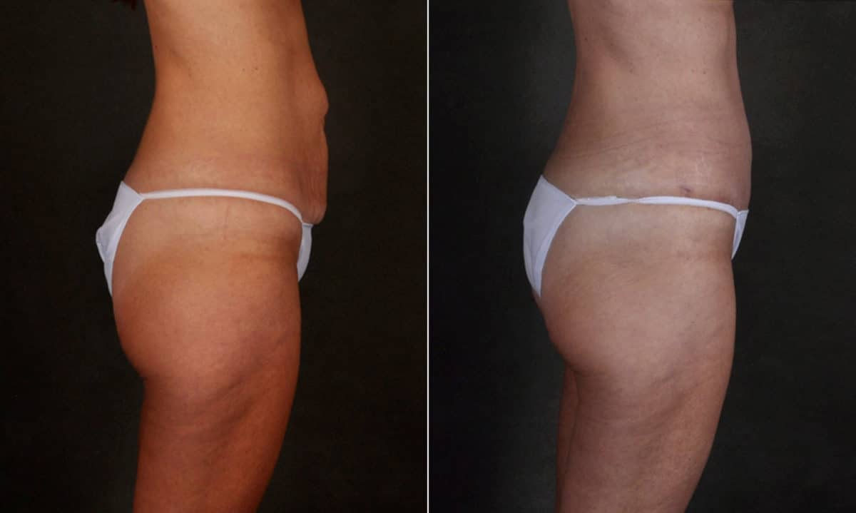 Case 17253, Tummy Tuck Before and After Photos Tummy Tuck Before and After Photos in Omaha, NE, Case 17253