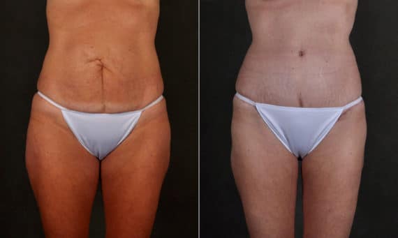 Tummy Tuck Before and After Photos in Omaha, NE, Case 17253