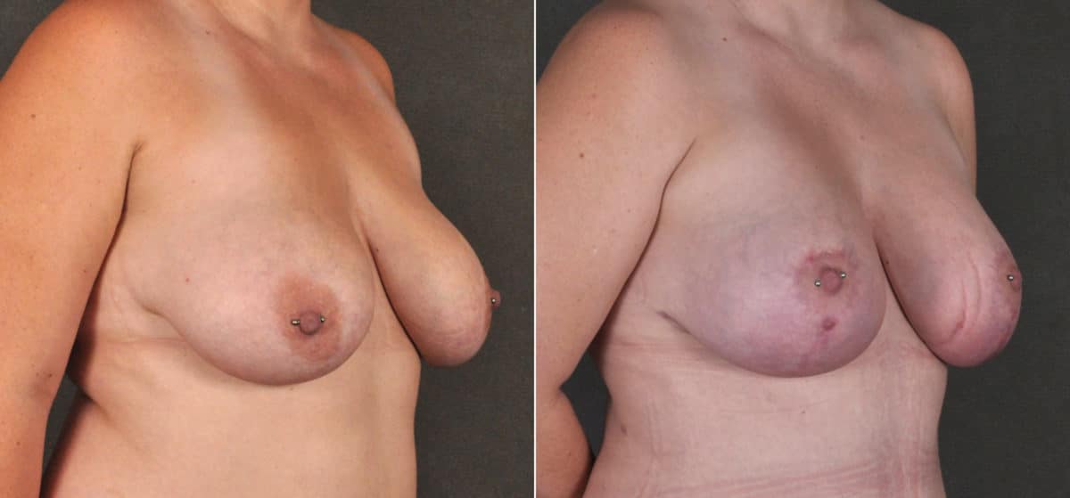 Breast Lift Before and After Photos in Omaha, NE, Case 17264