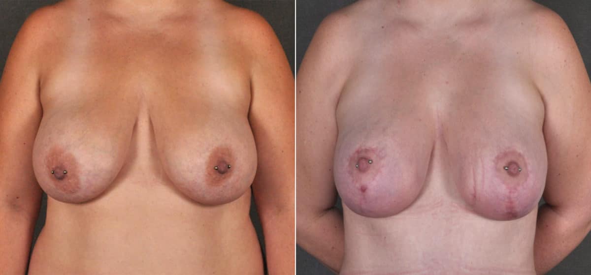 Breast Lift Before and After Photos in Omaha, NE, Case 17264