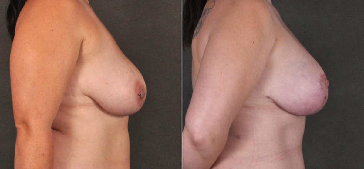 Breast Lift Before and After Photos in Omaha, NE, Case 17264