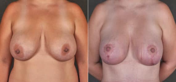 Breast Lift Before and After Photos in Omaha, NE, Case 17264