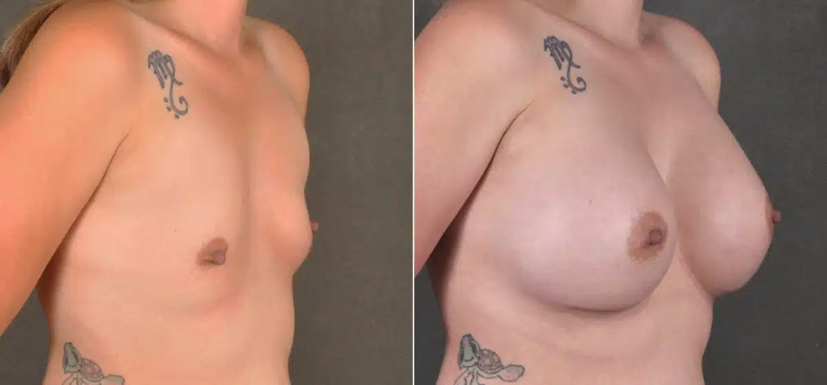 Breast Augmentation Before and After Photos in Omaha, NE, Case 17265