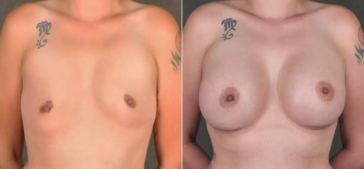 Breast Augmentation Before and After Photos in Omaha, NE, Case 17265