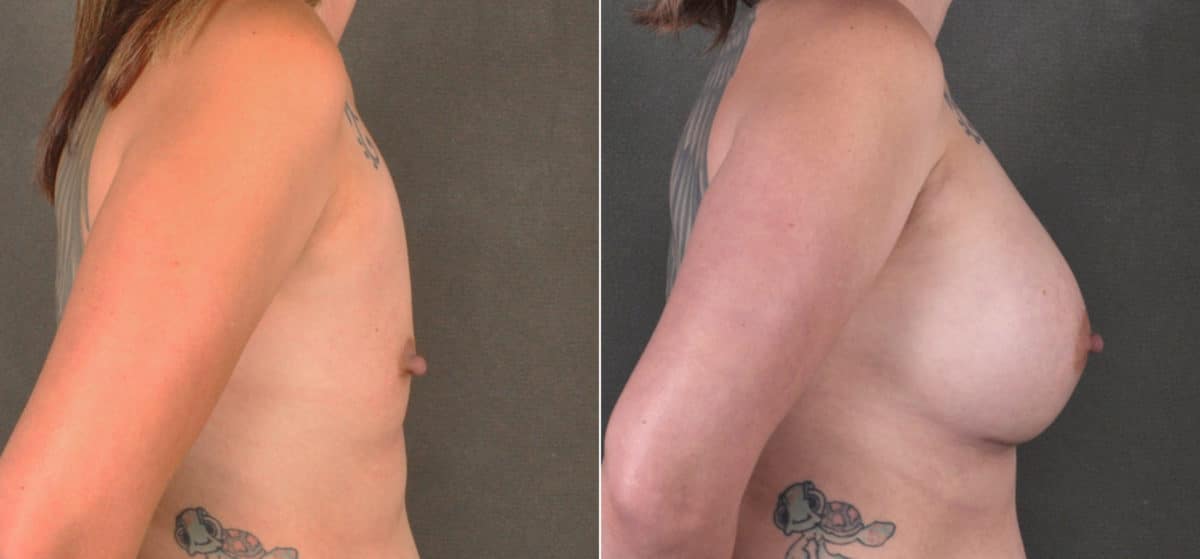 Breast Augmentation Before and After Photos in Omaha, NE, Case 17265