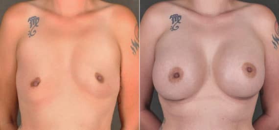 Breast Augmentation Before and After Photos in Omaha, NE, Case 17265