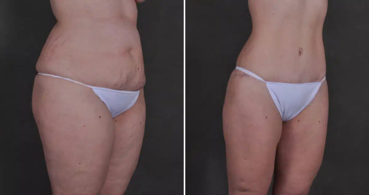 Tummy Tuck Before and After Photos in Omaha, NE, Case 9887