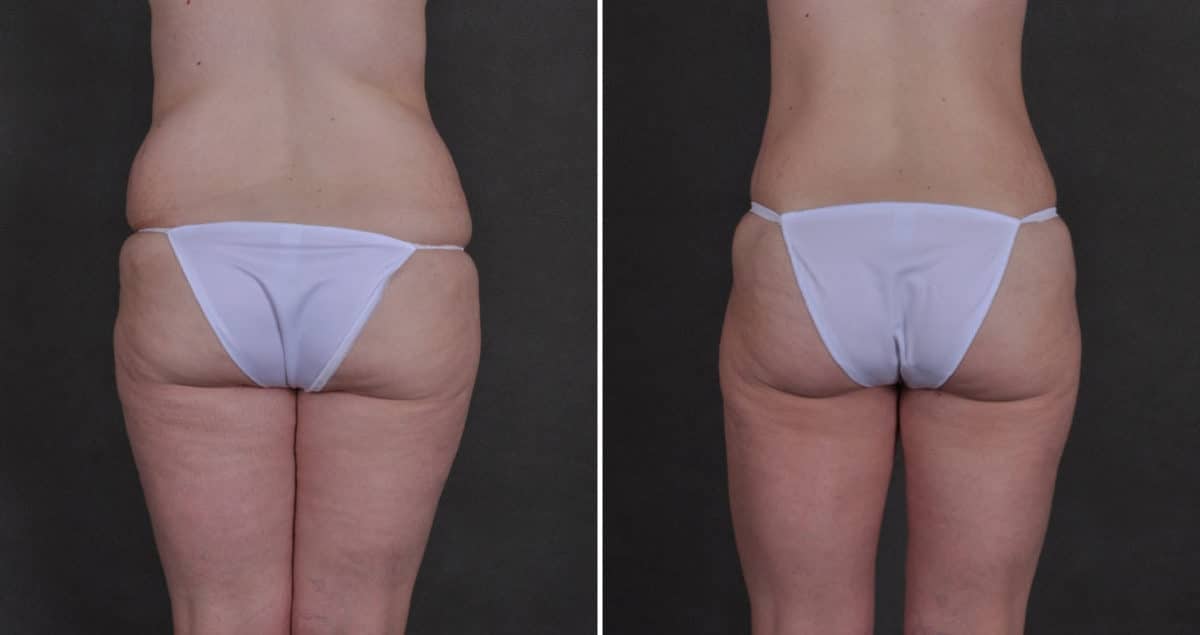 Tummy Tuck Before and After Photos in Omaha, NE, Case 9887