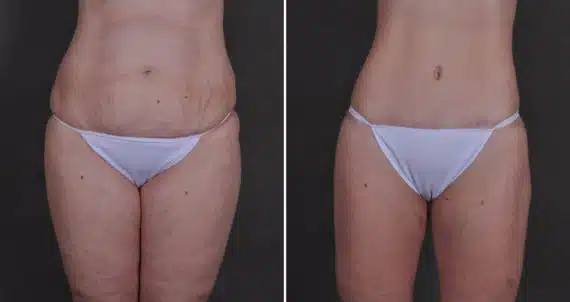 Sculptures Below The Knee Girdle - Shop Omaha Liposuction