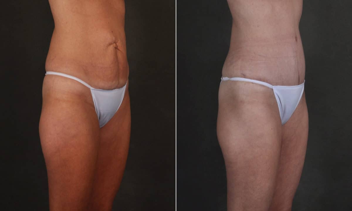 Liposuction Before and After Photos in Omaha, NE, Case 17411