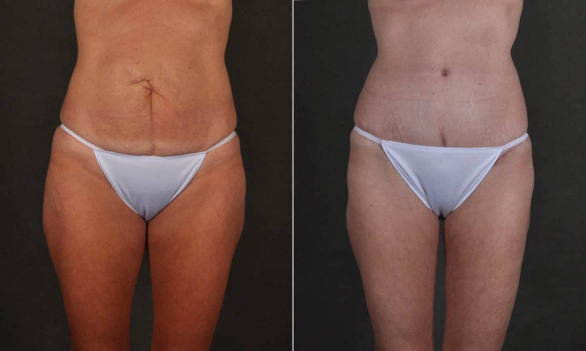 Liposuction Before and After Photos in Omaha, NE, Case 17411