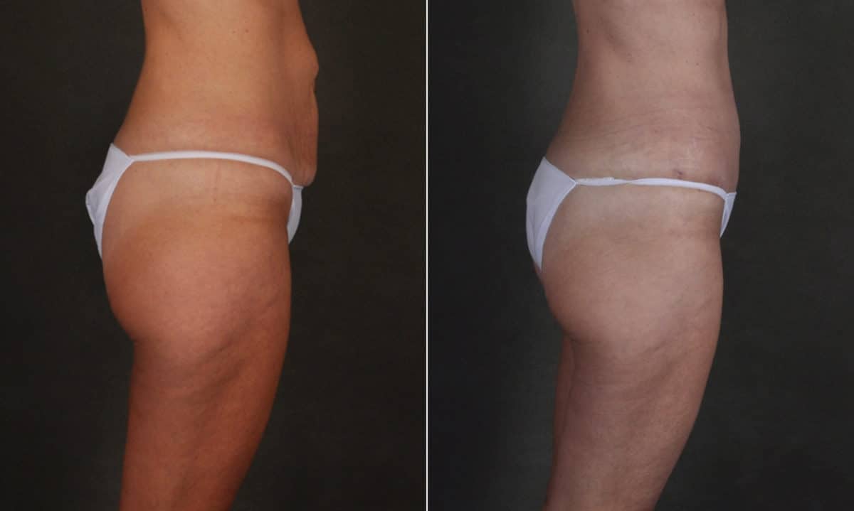 Liposuction Before and After Photos in Omaha, NE, Case 17411