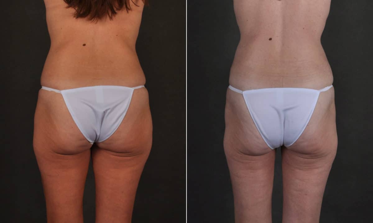 Liposuction Before and After Photos in Omaha, NE, Case 17411