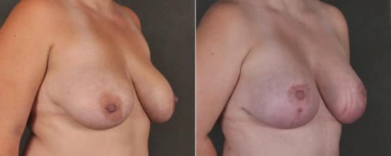 Breast Augmentation Before and After Photos in Omaha, NE, Case 17412