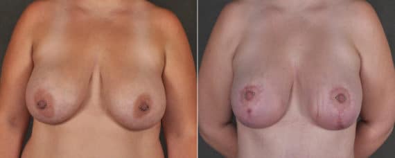 Breast Augmentation Before and After Photos in Omaha, NE, Case 17412