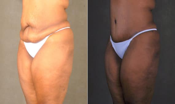 Liposuction Before and After Photos in Omaha, NE, Case 17501