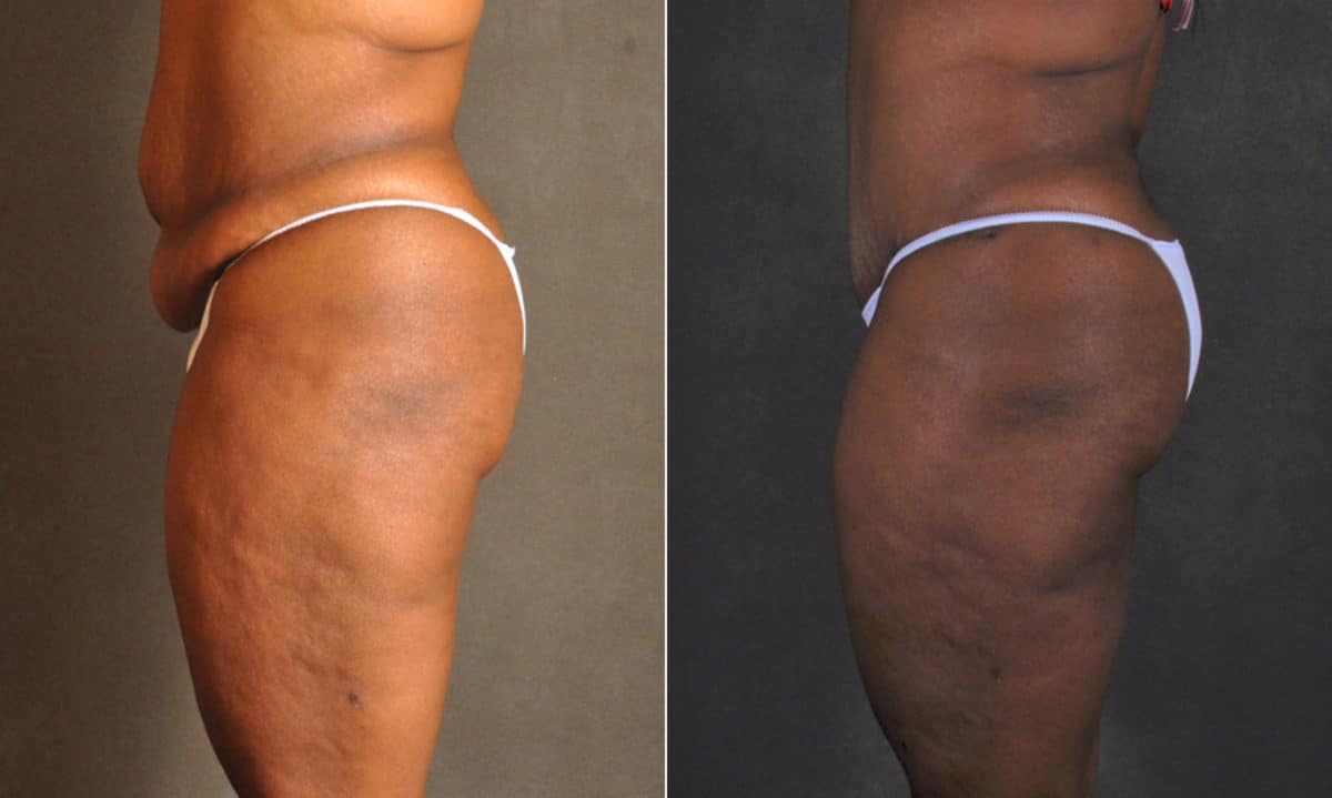 Liposuction Before and After Photos in Omaha, NE, Case 17501