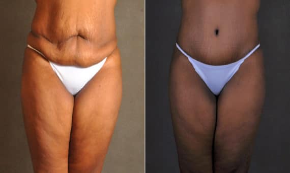 Liposuction Before and After Photos in Omaha, NE, Case 17501