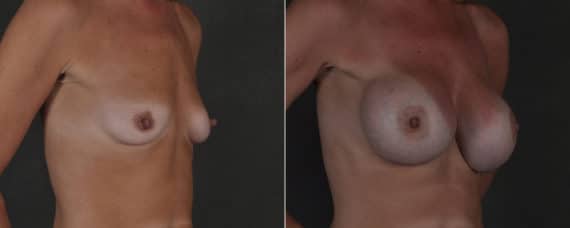 Breast Augmentation Before and After Photos in Omaha, NE, Case 17506