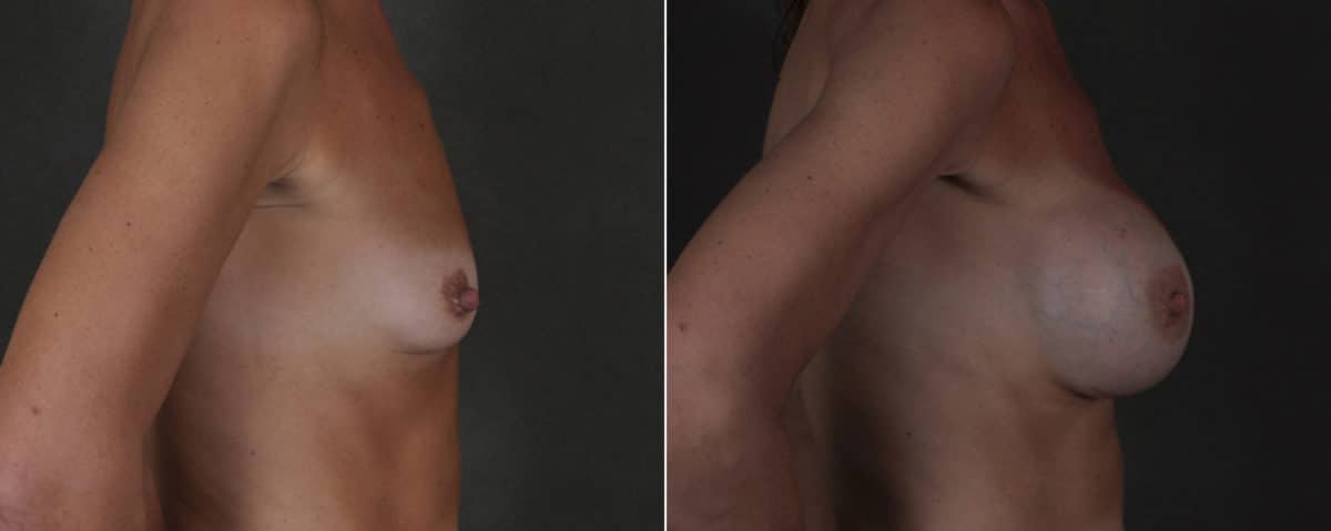 Breast Augmentation Before and After Photos in Omaha, NE, Case 17506