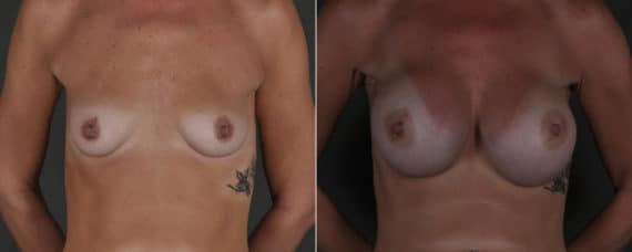 Breast Augmentation Before and After Photos in Omaha, NE, Case 17506