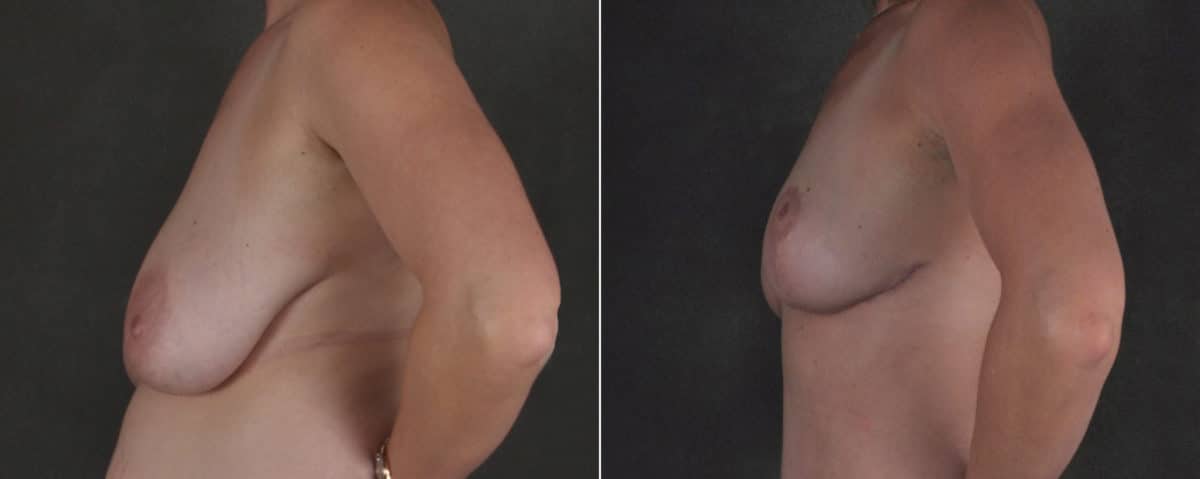 Mommy Makeover Before and After Photos in Omaha, NE, Case 17518