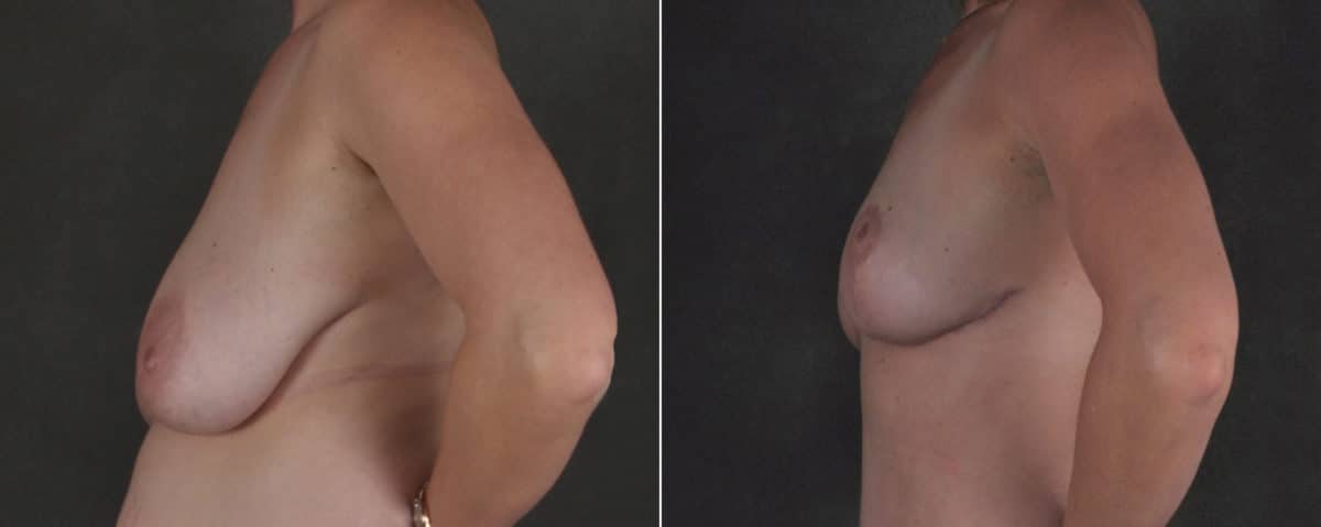 Breast Reduction Before and After Photos in Omaha, NE, Case 17519