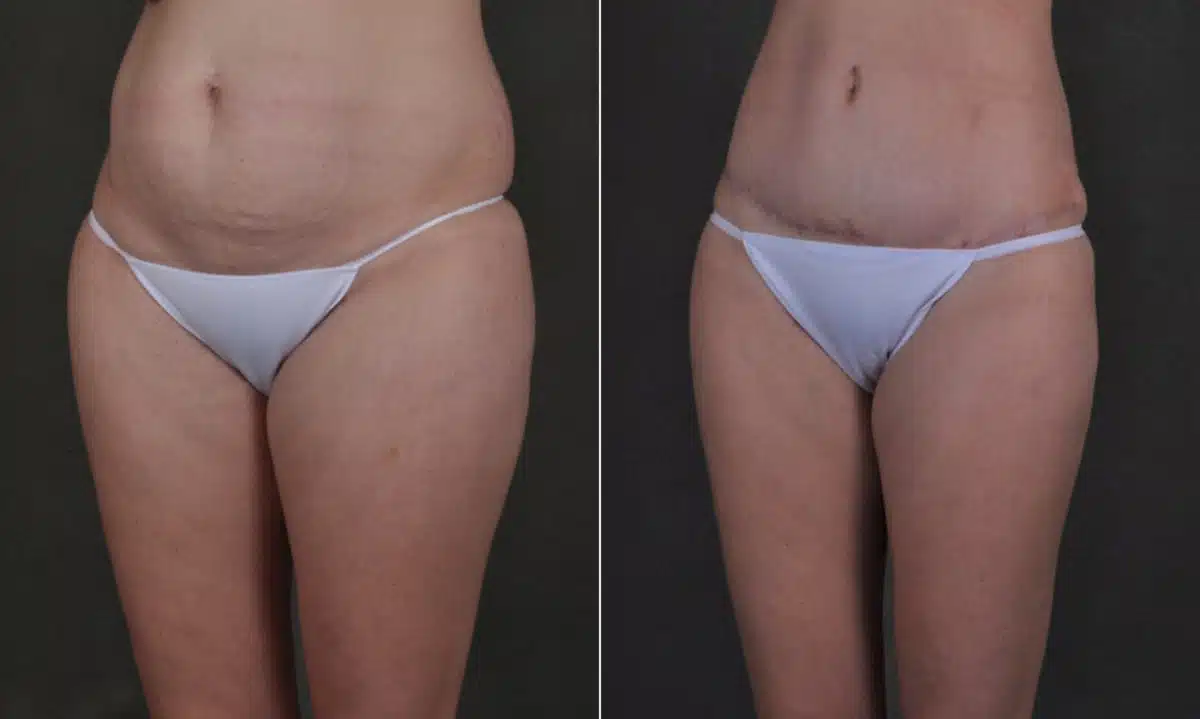 Tummy Tuck Before and After Photos in Omaha, NE, Case 17520